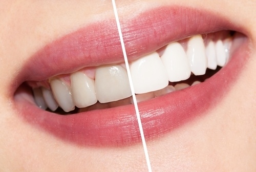 pros-y-contras-del-blanqueamiento-dental-1-Dec-17-2022-11-04-45-9451-PM